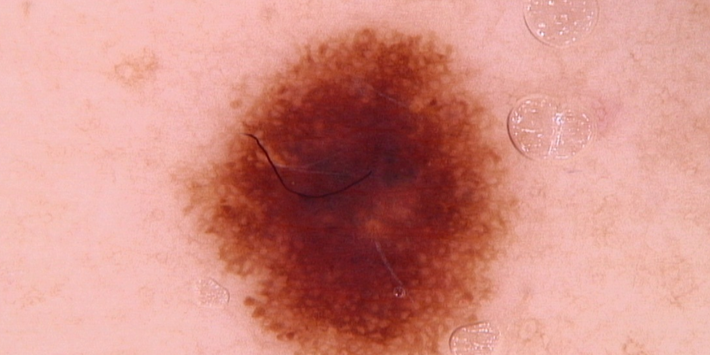 early melanoma dermoscopy